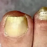Discolored nail